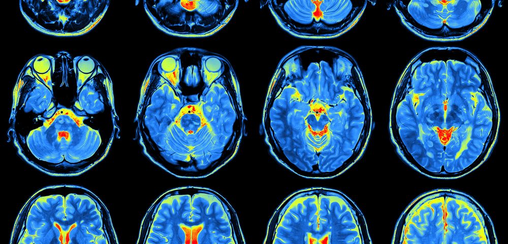 Pet scan for brain activity