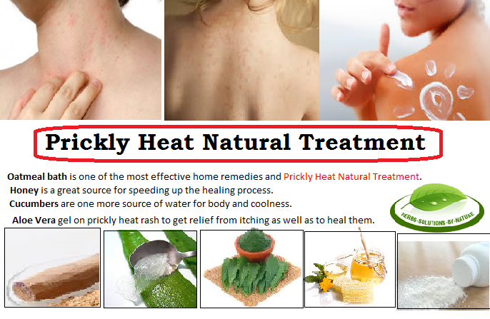 Top 10 Home Remedies for Prickly Heat - JKYog Naturopathy Hospital