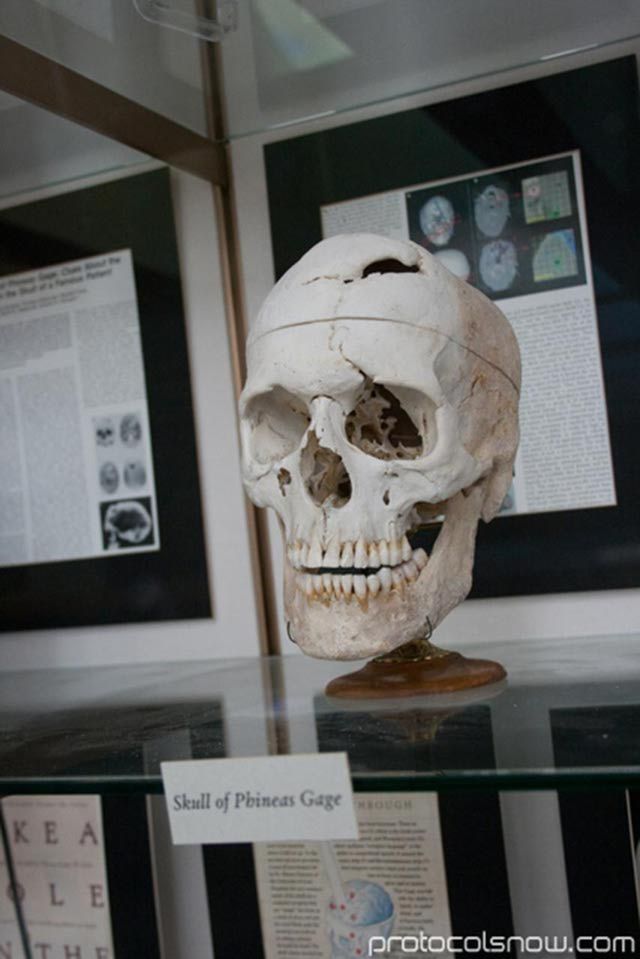 Phineas Gage Injury