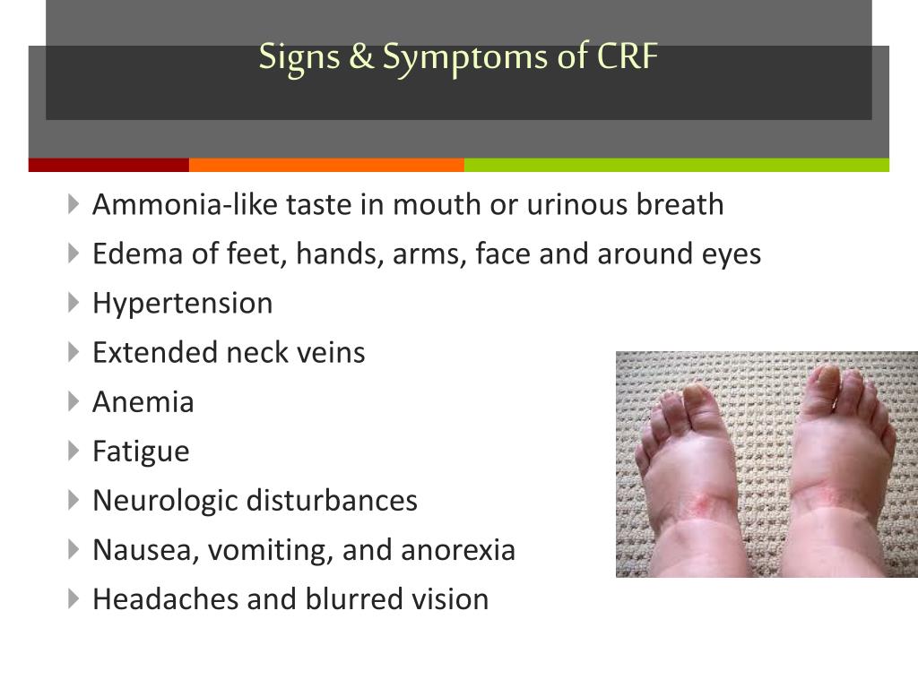 Anorexia signs and symptoms