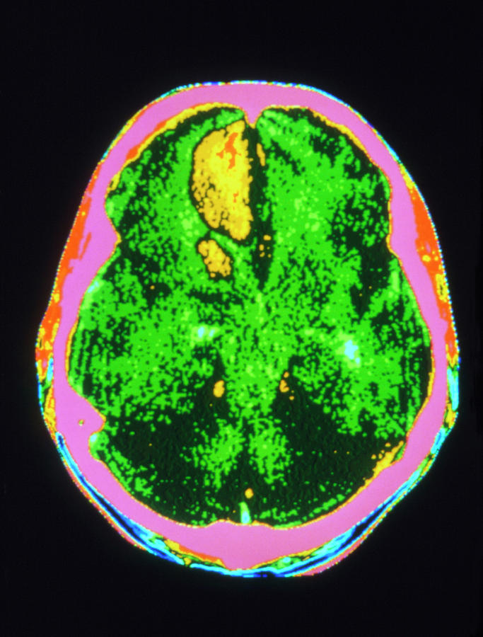 What scan shows brain activity