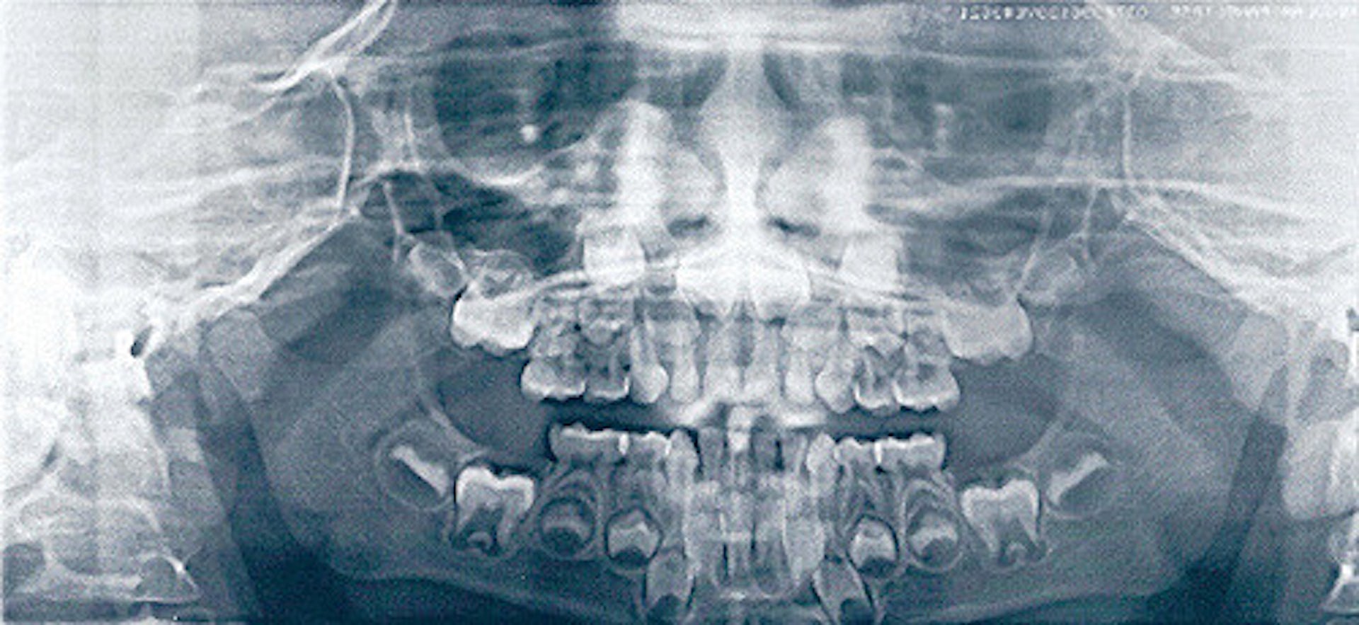 Why are my teeth falling out