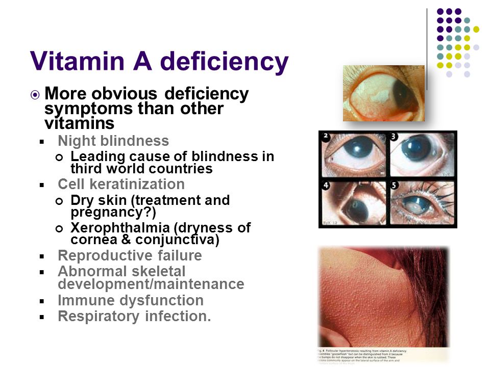 Vitamin deficiency. Vitamin d deficiency Symptoms. Vitamin в3 deficiency Symptoms. Vitamin deficiency 3d.